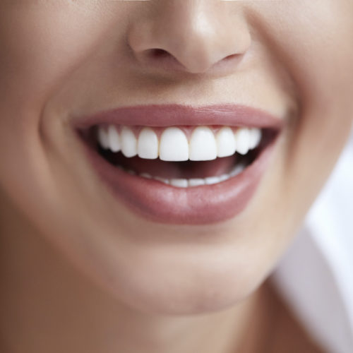 Carillas dentales: qué son y qué opciones existen